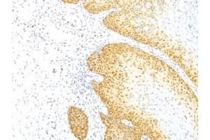 Formalin-fixed, paraffin-embedded human cervical cancer stained with p27Kip1 antibody (KIP1/769) (CDKN1B Antikörper)