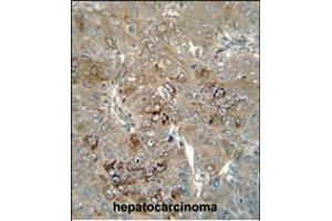 CES4 antibody (N-term) (ABIN654667 and ABIN2844363) immunohistochemistry analysis in formalin fixed and paraffin embedded human hepatocarcinoma followed by peroxidase conjugation of the secondary antibody and DAB staining. (CES1P1 Antikörper  (N-Term))