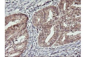 Immunohistochemical staining of paraffin-embedded Adenocarcinoma of Human endometrium tissue using anti-HLCS mouse monoclonal antibody.