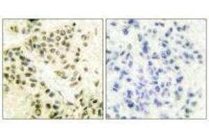 Immunohistochemical analysis of paraffin-embedded human breast carcinoma tissue using DNA-PK antibody. (PRKDC Antikörper)