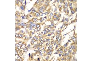 Immunohistochemistry of paraffin-embedded human esophageal cancer using VTI1B antibody at dilution of 1:100 (x40 lens). (VTI1B Antikörper)