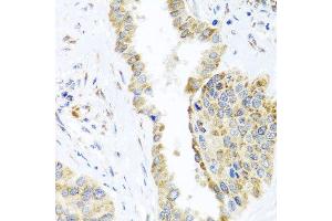 Immunohistochemistry of paraffin-embedded human lung cancer using DARS2 antibody at dilution of 1:100 (x40 lens). (DARS2 Antikörper)