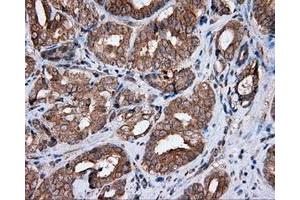 Immunohistochemical staining of paraffin-embedded Carcinoma of liver tissue using anti-MTRF1L mouse monoclonal antibody. (MTRF1L Antikörper)