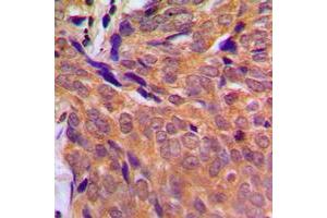 Immunohistochemical analysis of CHK1 staining in human breast cancer formalin fixed paraffin embedded tissue section. (CHEK1 Antikörper  (Center))