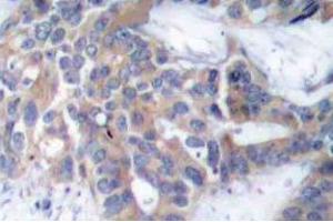 Immunohistochemistry (IHC) analyzes of p-MEK-1/2 antibody in paraffin-embedded human breast carcinoma tissue. (MEK1 Antikörper  (pSer218, pSer222))