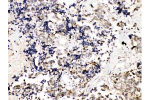 TRF2 was detected in paraffin-embedded sections of human lung cancer tissues using rabbit anti- TRF2 Antigen Affinity purified polyclonal antibody (Catalog # ) at 1 µg/mL. (TRF2 Antikörper  (AA 81-287))