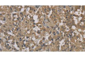 Immunohistochemistry of paraffin-embedded Human thyroid cancer tissue using DCTN3 Polyclonal Antibody at dilution 1:70