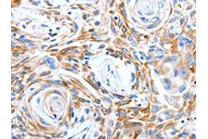 The image on the left is immunohistochemistry of paraffin-embedded Human esophagus cancer tissue using ABIN7191315(LRIG3 Antibody) at dilution 1/50, on the right is treated with synthetic peptide. (LRIG3 Antikörper)