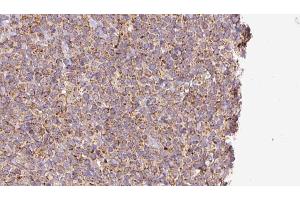 ABIN6273191 at 1/100 staining Human lymph cancer tissue by IHC-P.