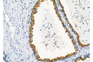 ABIN6258921 and ABIN6273360 at 1/100 staining Human prostate cancer by IHC-P.