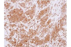 AP31125PU-N RGS10 antibody staining of Paraffin-Embedded Breast Carcinoma at 1/250 dilution.