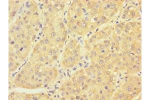 Immunohistochemistry of paraffin-embedded human liver cancer using ABIN7166614 at dilution of 1:100 (PCBD1 Antikörper  (AA 2-104))