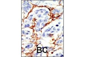 Formalin-fixed and paraffin-embedded human cancer tissue reacted with the primary antibody, which was peroxidase-conjugated to the secondary antibody, followed by DAB staining. (DOK2 Antikörper  (C-Term))