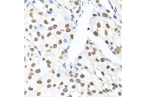 Immunohistochemistry of paraffin-embedded human prostate cancer using Ku80 antibody (ABIN6130932, ABIN6150308, ABIN6150310 and ABIN6217336) at dilution of 1:100 (40x lens). (XRCC5 Antikörper  (AA 540-732))
