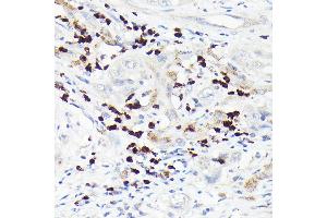 Immunohistochemistry of paraffin-embedded human liver cancer using MMP8 Rabbit pAb (ABIN3015770, ABIN3015771, ABIN3015772 and ABIN6219115) at dilution of 1:150 (40x lens). (MMP8 Antikörper  (AA 101-467))
