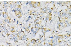 Immunohistochemistry of paraffin-embedded Human breast cancer using ATP5J Polyclonal Antibody at dilution of 1:100 (40x lens). (ATP5J Antikörper)