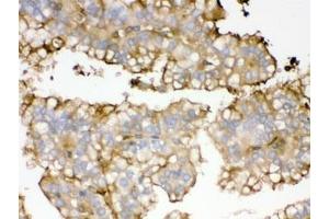 IHC testing of FFPE human kidney cancer tissue with APOA1 antibody. (APOA1 Antikörper)
