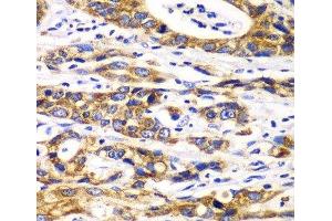 Immunohistochemistry of paraffin-embedded Human gastric cancer using RPN1 Polyclonal Antibody at dilution of 1:100 (40x lens). (RPN1 Antikörper)