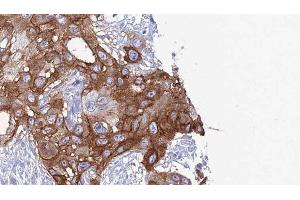 ABIN6277791 at 1/100 staining Human Head and neck cancer tissue by IHC-P. (CD11c Antikörper  (N-Term))