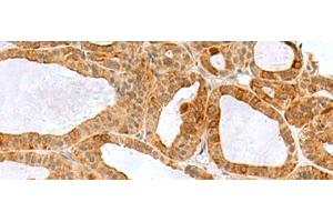 Immunohistochemistry of paraffin-embedded Human thyroid cancer tissue using RPS16 Polyclonal Antibody at dilution of 1:60(x200) (RPS16 Antikörper)