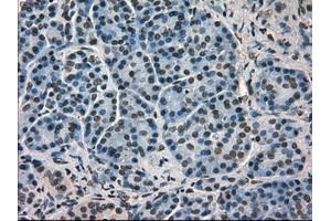 Immunohistochemical staining of paraffin-embedded Carcinoma of kidney tissue using antiHSPA9mouse monoclonal antibody. (HSPA9 Antikörper)