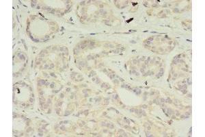 Immunohistochemistry of paraffin-embedded human breast cancer using ABIN7175188 at dilution of 1:100 (VSIG2 Antikörper  (AA 24-243))