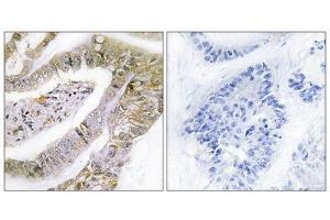 Immunohistochemistry analysis of paraffin-embedded human lung carcinoma tissue using TACC3 antibody. (TACC3 Antikörper  (C-Term))