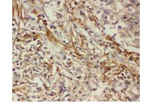 Immunohistochemistry analysis of paraffin-embedded human lung cancer tissue using COX2 Antibody (1/200 dilution). (COX2 Antikörper)