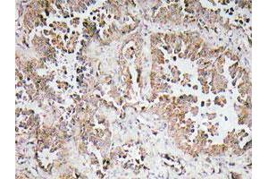 Immunohistochemical analysis of paraffin-embedded human lung cancer tissue using OR6P1 polyclonal antibody . (OR6P1 Antikörper)