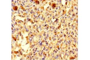 Immunohistochemistry of paraffin-embedded human melanoma using ABIN7146155 at dilution of 1:100 (C2 Calcium-Dependent Domain-Containing Protein 6 (C2CD6) (AA 401-623) Antikörper)