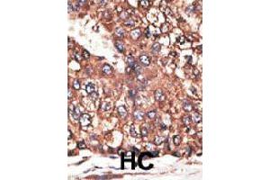 Formalin-fixed and paraffin-embedded human hepatocellular carcinoma tissue reacted with LEPR polyclonal antibody  , which was peroxidase-conjugated to the secondary antibody, followed by DAB staining. (Leptin Receptor Antikörper  (N-Term))
