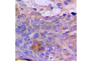 Immunohistochemical analysis of CSGALNACT1 staining in human breast cancer formalin fixed paraffin embedded tissue section. (CSGALNACT1 Antikörper  (Center))