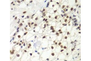 Immunohistochemistry of paraffin-embedded Human kidney cancer using MSH6 Polyclonal Antibody at dilution of 1:100 (40x lens). (MSH6 Antikörper)