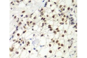 Immunohistochemistry of paraffin-embedded Human kidney cancer using MSH6 Polyclonal Antibody at dilution of 1:100 (40x lens).