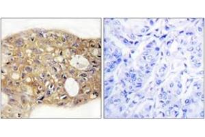 Immunohistochemistry analysis of paraffin-embedded human breast carcinoma tissue, using AGR3 Antibody. (AGR3 Antikörper  (AA 1-50))