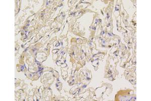Immunohistochemistry of paraffin-embedded human lung using ARRB1 antibody (ABIN5996907) at dilution of 1/100 (40x lens). (beta Arrestin 1 Antikörper)