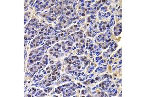 Immunohistochemistry of paraffin-embedded human liver cancer using HIRIP3 antibody (ABIN5974221) at dilution of 1/100 (40x lens). (HIRIP3 Antikörper)