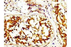 IHC image of ABIN7146664 diluted at 1:200 and staining in paraffin-embedded human breast cancer performed on a Leica BondTM system. (Caprin-1 Antikörper  (AA 573-703))
