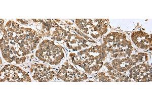 Immunohistochemistry of paraffin-embedded Human esophagus cancer tissue using ATXN7L3 Polyclonal Antibody at dilution of 1:35(x200) (ATXN7L3 Antikörper)