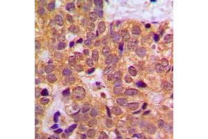 Immunohistochemical analysis of STAT1 staining in human breast cancer formalin fixed paraffin embedded tissue section.