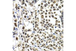 Immunohistochemistry of paraffin-embedded human breast cancer using IRF2 antibody (ABIN5971383) at dilution of 1/200 (40x lens). (IRF2 Antikörper)