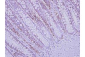 IHC-P Image Immunohistochemical analysis of paraffin-embedded human colon carcinoma, using RPLP2, antibody at 1:500 dilution. (RPLP2 Antikörper  (Center))