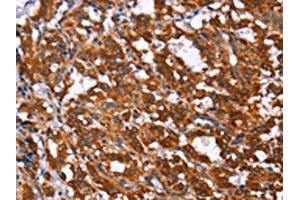 The image on the left is immunohistochemistry of paraffin-embedded Human thyroid cancer tissue using ABIN7190857(GPR65 Antibody) at dilution 1/15, on the right is treated with synthetic peptide. (GPR65 Antikörper)