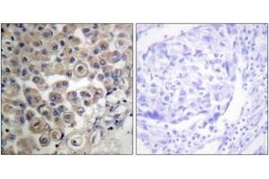 Immunohistochemistry analysis of paraffin-embedded human breast carcinoma tissue, using PLC beta3 (Ab-537) Antibody. (PLCB3 Antikörper  (AA 503-552))