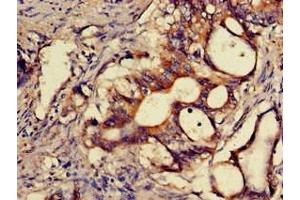 Immunohistochemistry of paraffin-embedded human colon cancer using ABIN7170356 at dilution of 1:100 (SNX15 Antikörper  (AA 144-321))