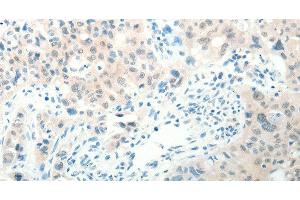 Immunohistochemistry of paraffin-embedded Human lung cancer tissue using RAB25 Polyclonal Antibody at dilution 1:50 (RAB25 Antikörper)