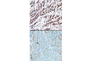 IHC testing using HTRA2 monoclonal antibody, clone 196C429  shows cytoplasmic staining in stomach tumor tissue (A) and very weak staining in normal stomach tissue (B) . (HTRA2 Antikörper  (AA 335-350))