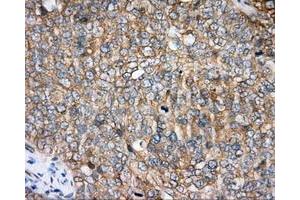 Immunohistochemical staining of paraffin-embedded Adenocarcinoma of colon tissue using anti-BTK mouse monoclonal antibody. (BTK Antikörper)