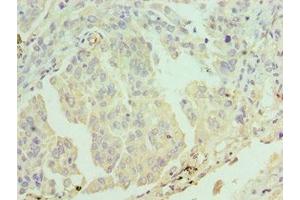 Immunohistochemistry of paraffin-embedded human lung cancer using ABIN7171956 at dilution of 1:100 (ERCC2 Antikörper  (AA 1-300))