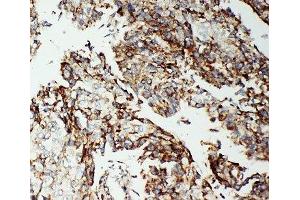 IHC-P: Apoptosis-Inducing Factor antibody testing of human lung cancer tissue (AIF Antikörper  (C-Term))